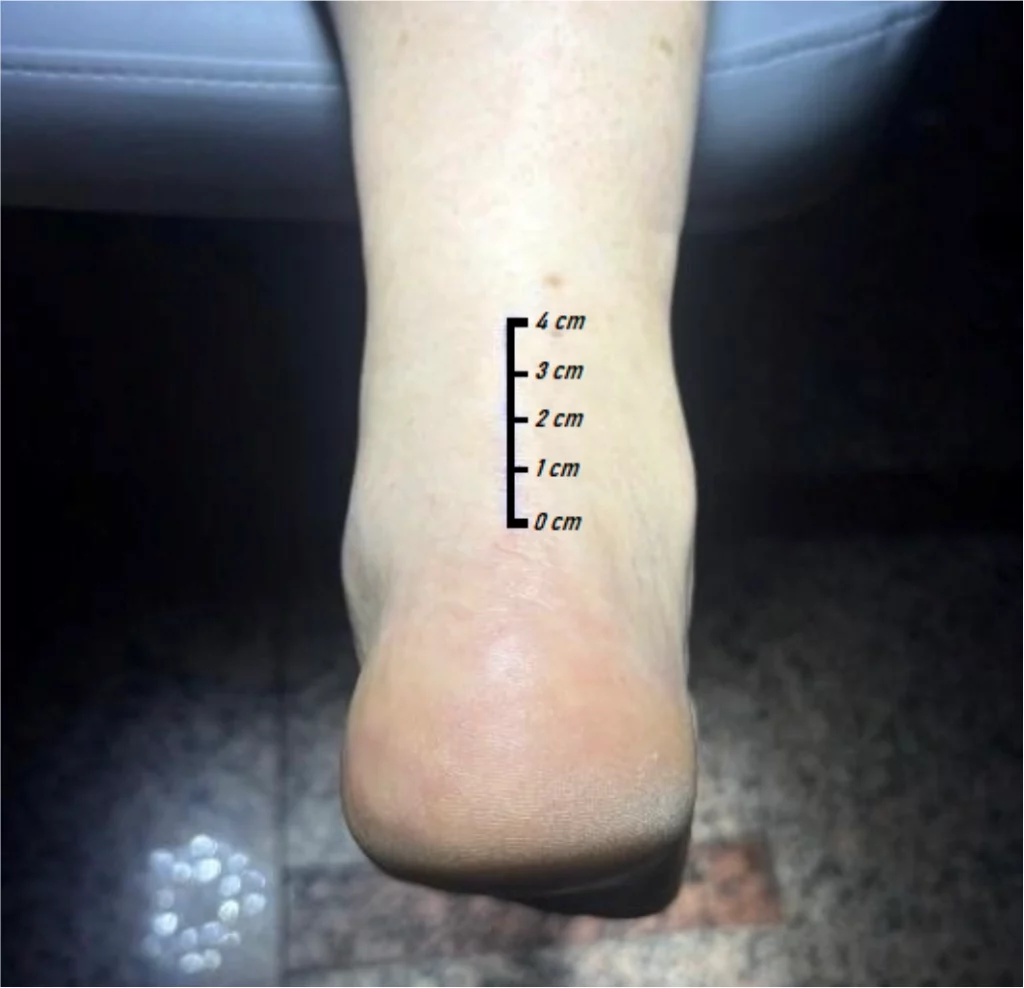 “Age is associated with Achilles tendon thickness in older adults: an ultrasound case–control study with intra-observer reliability”